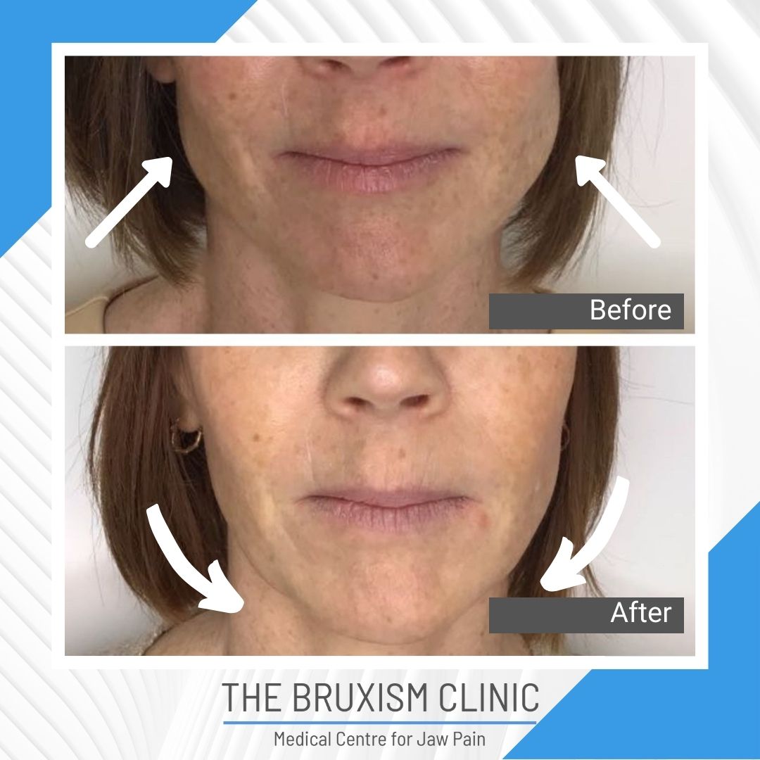 TBC Before and After 1 xc