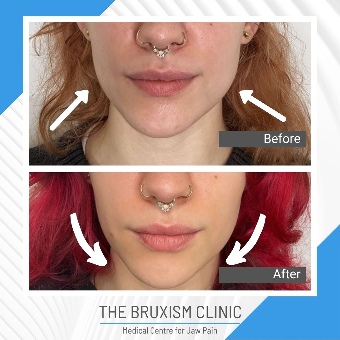 TBC Before and After 1i