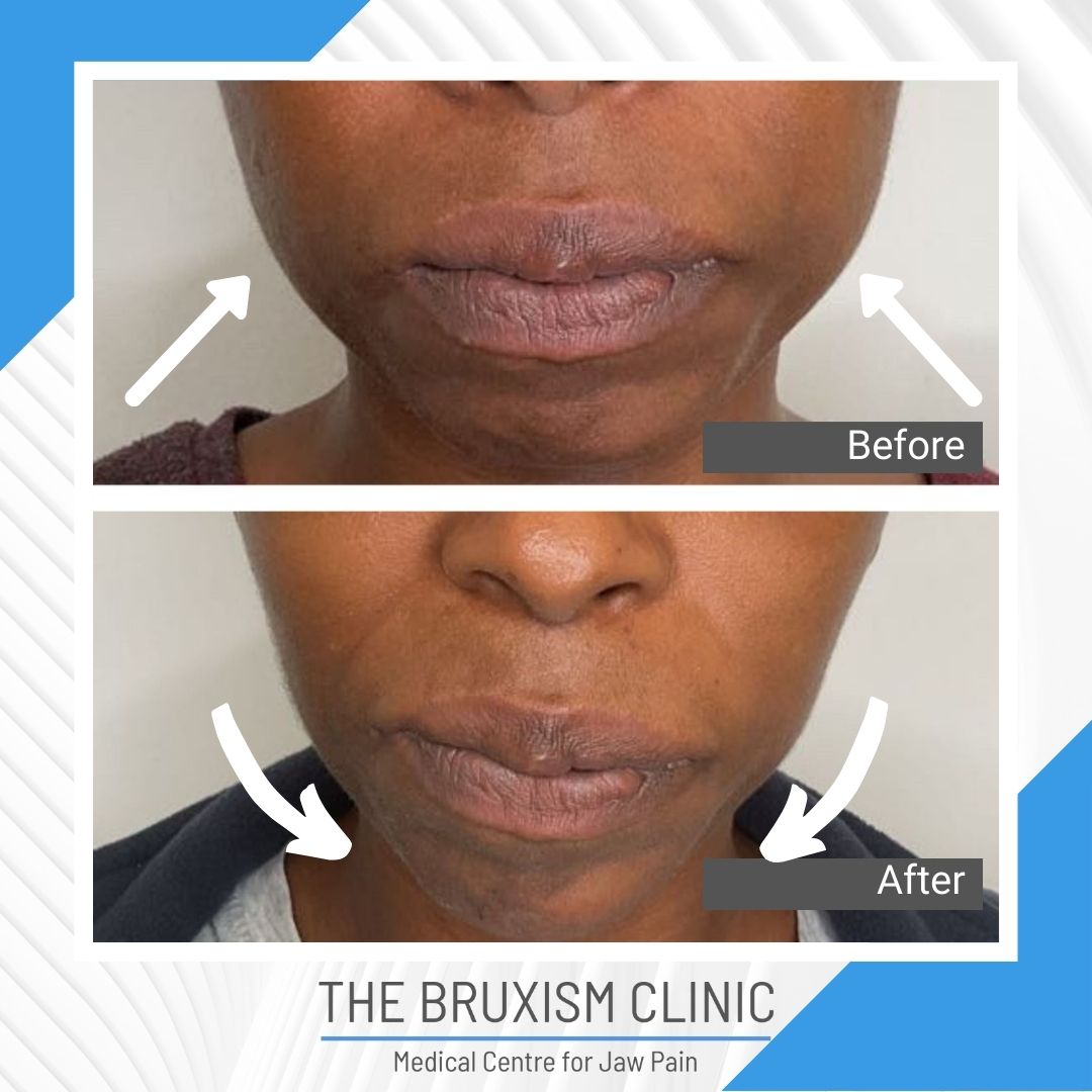 TBC Before and After 2