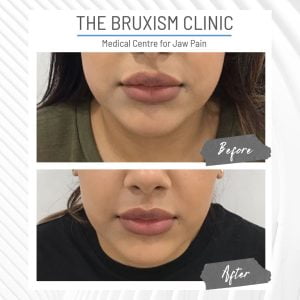 Jaw Slimming Botox Before and After