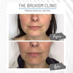 Jaw Slimming botox antiwrinkle masseter slimming