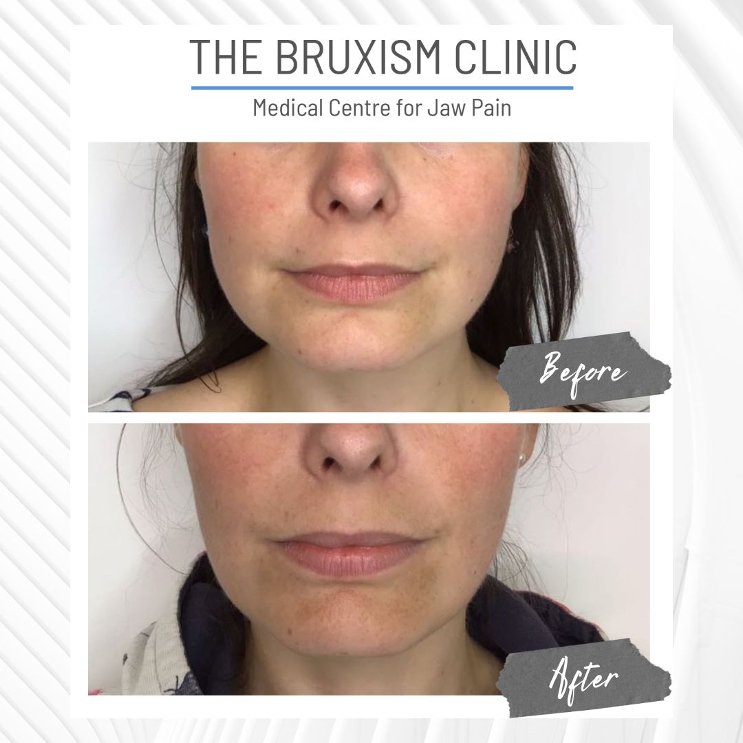 TBC Before and After 67