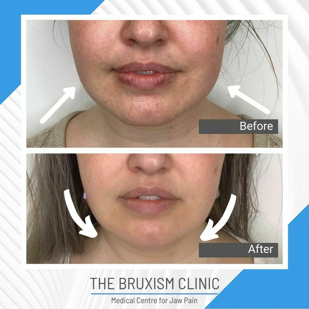 TBC Before and Afterl